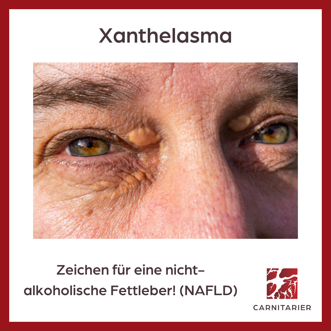 Person mit Xanthelasmen